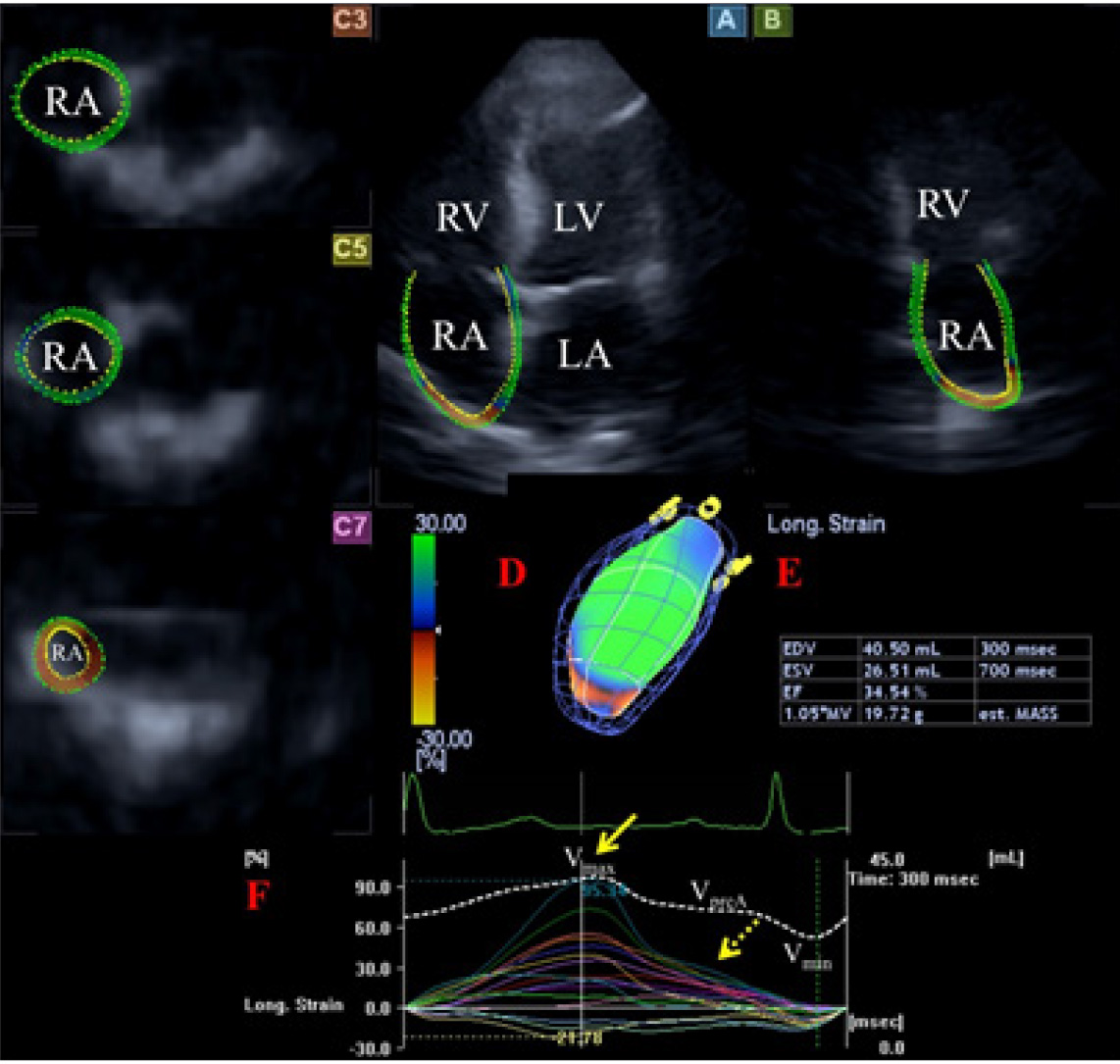Three-dimensional Speckle Tracking Echocardiography in Light Chain