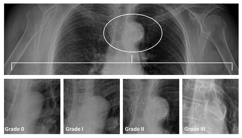 Aortic Arch Calcification On Routine Chest Radiography Is Strongly And